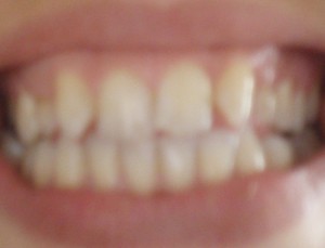 tiras blanqueadoras dientes