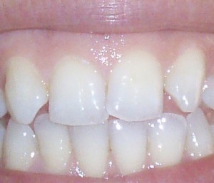 tiras blanqueadoras dientes tiras blanqueadoras dientes
